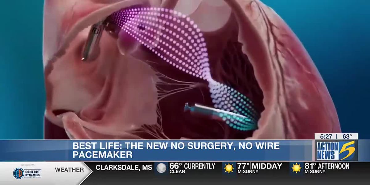 Ground Wire Pacemaker Best Life: The new “No Surgery, No Wires” pacemaker